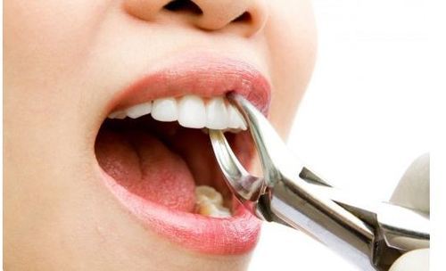 TOOTH EXTRACTION CLINIC